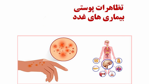 ناراحتی های پوستی در بیماری های غدد